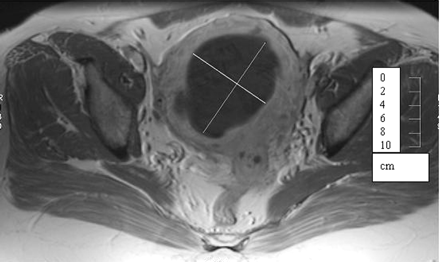MR scan of Fibroids