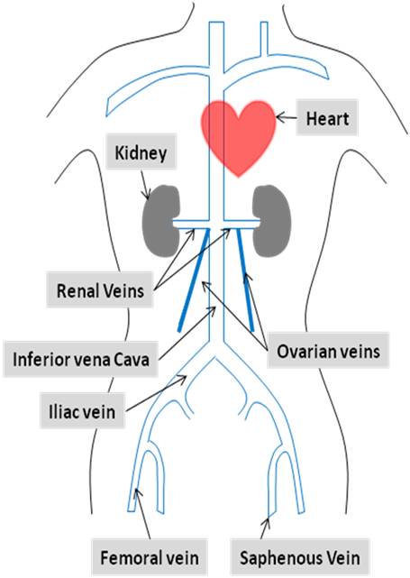 mare pelvic varicoza)