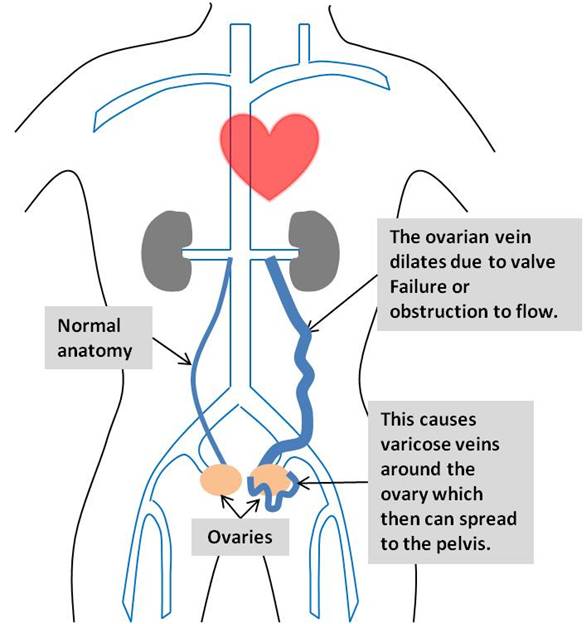 mare pelvic varicoza)