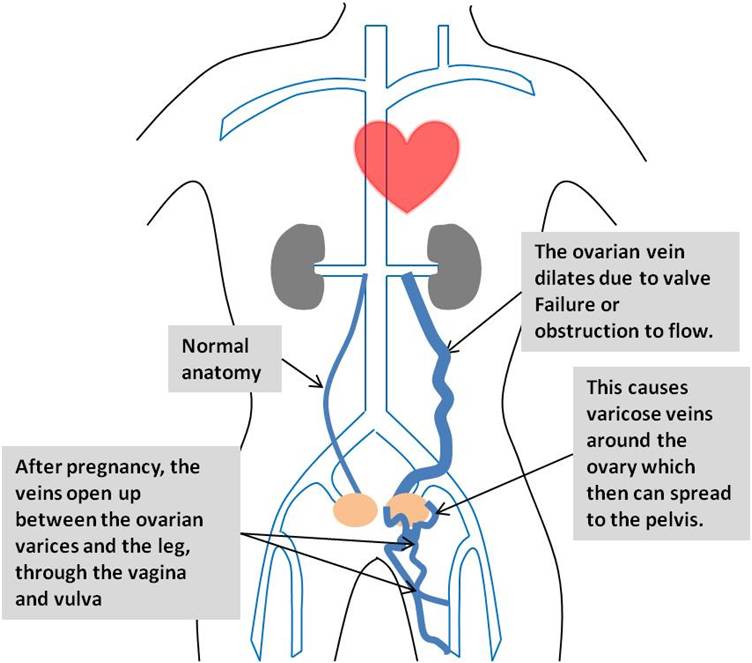 Pelvic Congestion Syndrome  FloridaInterventionalSpecialists.com