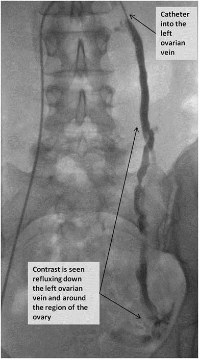 Pelvic Venous Congestion Syndrome | BSIR venous diagram 